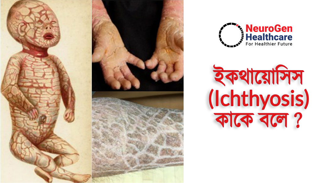 ইকথায়োসিস (Ichthyosis) কাকে বলে ? ( Tamannyat Binte Eshaque - Genetic Counselor )